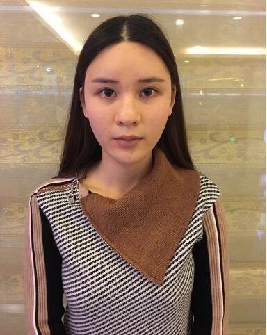 做肋軟骨隆鼻之前的圖片