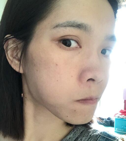 北京藝星整形專家廖苑利做光子嫩膚怎么樣？廖苑利光子嫩膚案例效果展示