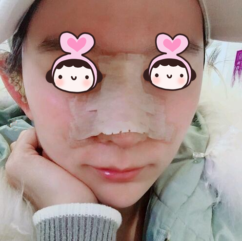 廈門海峽整形專家王翼耕做隆鼻案例分享 廈門海峽整形專家王翼耕做隆鼻案例分享