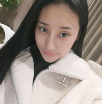 北京葉子整形美容醫(yī)院做焊接雙眼皮效果怎么樣？北京葉子整形焊接雙眼皮案例展示