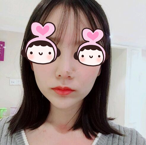 廈門海峽整形專家王翼耕做隆鼻案例分享 廈門海峽整形專家王翼耕做隆鼻案例分享