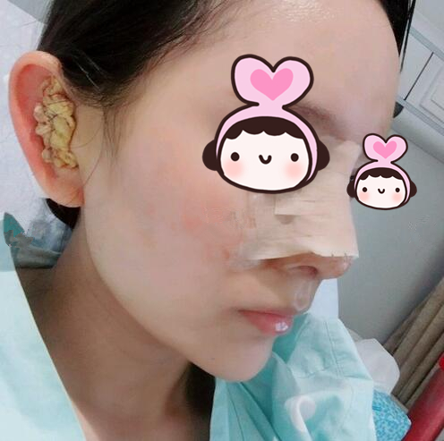 廈門海峽整形專家王翼耕做隆鼻案例分享 廈門海峽整形專家王翼耕做隆鼻案例分享