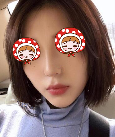 北京京韓醫(yī)療硅膠隆鼻案例