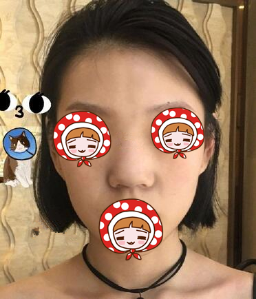 北京京韓醫(yī)療美容診所做硅膠隆鼻效果怎么樣？北京京韓醫(yī)療硅膠隆鼻案例