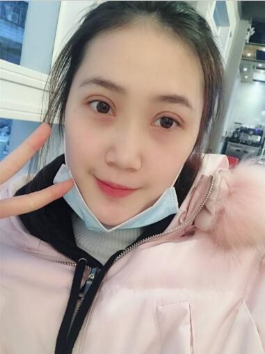 昆明大華醫(yī)療美容醫(yī)院做切開雙眼皮怎么樣？切開雙眼皮案例分享