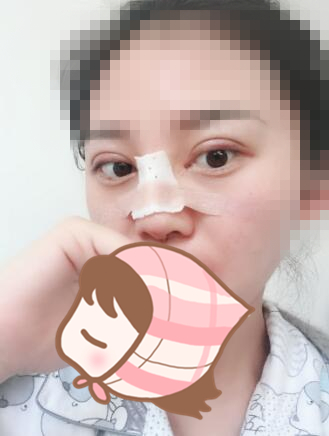 北京延世醫(yī)療整形專(zhuān)家周宜國(guó)做開(kāi)外眼角技術(shù)怎么樣？