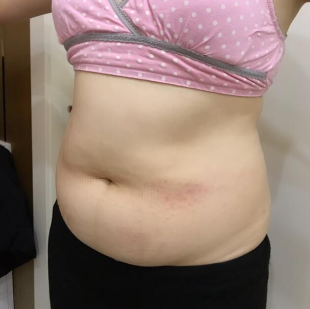 廣州星團(tuán)醫(yī)學(xué)整形醫(yī)生顧鵬做腹部吸脂效果怎么樣？顧鵬腹部吸脂案例展示