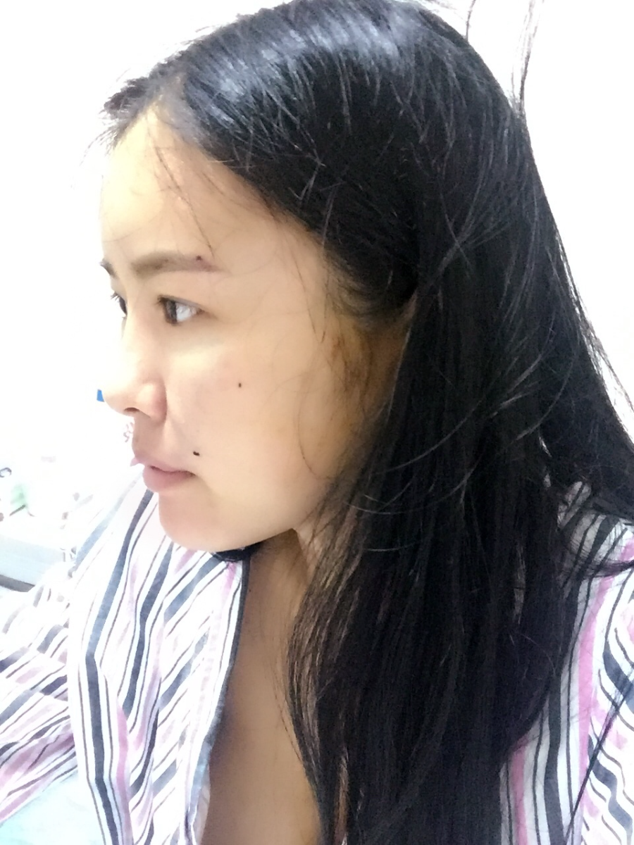 西安莎曼妃醫(yī)療美容醫(yī)院醫(yī)生樸俊做自體脂肪豐太陽(yáng)穴效果怎么樣？