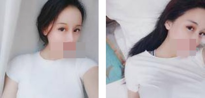 寧波美仁整形美容醫(yī)院李英大醫(yī)生做切開雙眼皮效果怎么樣？