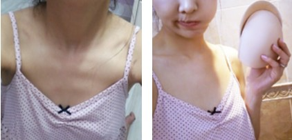 沈陽(yáng)杏林整形美容醫(yī)院崔昌墉醫(yī)生做假體隆胸技術(shù)怎么樣？附案例