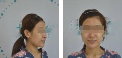 昆明麗都整形醫(yī)生孟春麗做面部自體脂肪填充效果怎么樣？