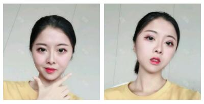 深圳嶺南醫(yī)院整形醫(yī)生丁祖鑫做假體豐太陽穴案例效果對比圖