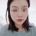 濟(jì)南曹博士美容整形醫(yī)院做玻尿酸豐面頰怎么樣？陳正喜醫(yī)生案例