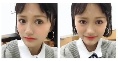 東莞華美做切開雙眼皮怎么樣？朱清武醫(yī)生切開雙眼皮案例分享