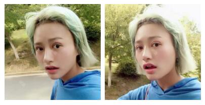 朱清武醫(yī)生切開雙眼皮案例分享 朱清武醫(yī)生切開雙眼皮案例分享