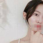 蘇州愛思特醫(yī)療美容醫(yī)院翟奔宇醫(yī)生肋軟骨隆鼻案例效果對(duì)比圖