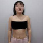 南寧伊美整形醫(yī)生凌宏量做自體脂肪隆胸怎么樣？自體脂肪隆胸案例