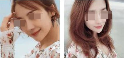 上海攸維醫(yī)療美容診所整形醫(yī)生李靜做膨體隆鼻效果怎么樣？附案例展示