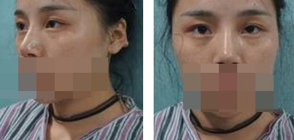 寧波美仁整形美容醫(yī)院李英大醫(yī)生做切開雙眼皮效果怎么樣？