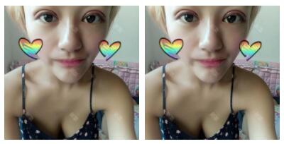 東莞華美做切開雙眼皮怎么樣？朱清武醫(yī)生切開雙眼皮案例分享