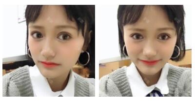 朱清武醫(yī)生切開雙眼皮案例分享 朱清武醫(yī)生切開雙眼皮案例分享