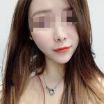 深圳尚虹醫(yī)療整形醫(yī)生藍劍雄做自體脂肪豐面頰效果怎么樣？附案例