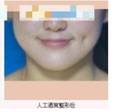 德州市第二人民醫(yī)院燒傷美容整形科張波濤醫(yī)生做酒窩成形術(shù)怎么樣？