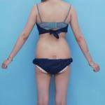 青島銘醫(yī)醫(yī)學(xué)整形醫(yī)生王殿棟做全身吸脂效果怎么樣？附案例展示