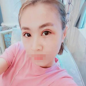 雙眼皮手術(shù)第二天