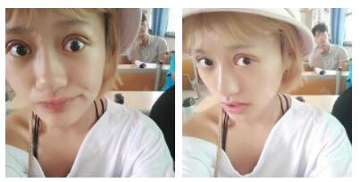 朱清武醫(yī)生切開雙眼皮案例分享 朱清武醫(yī)生切開雙眼皮案例分享