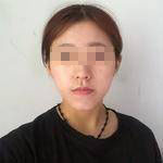 做完埋線提升后，松弛的臉蛋拜拜了