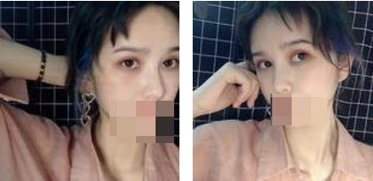 做了切開雙眼皮手術(shù)，才發(fā)現(xiàn)自己原來可以這么美！