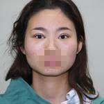 做了雙眼皮手術(shù)，讓我的眼睛更有神