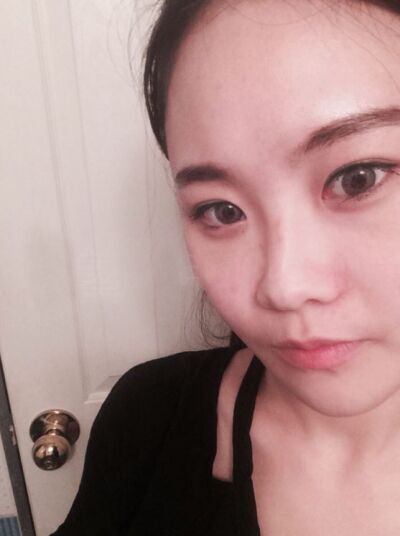 貴陽長江醫(yī)院整形美容中心韓盛斌醫(yī)生做自體脂肪隆鼻+全臉填充案例 貴陽長江醫(yī)院整形美容中心韓盛斌醫(yī)生做自體脂肪隆鼻+全臉填充案例