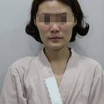 做完自體脂肪豐面頰后，我的面部比例更加完美了呢