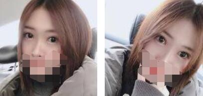 激光祛眼袋恢復過程 激光祛眼袋恢復過程