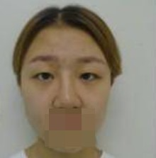 做了全切雙眼皮不僅外表變美了，內(nèi)心也更加自信了