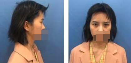 做了切開雙眼皮手術(shù)，才發(fā)現(xiàn)自己原來可以這么美！