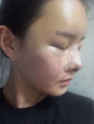 貴陽長江醫(yī)院整形美容中心韓盛斌醫(yī)生做自體脂肪隆鼻+全臉填充案例 貴陽長江醫(yī)院整形美容中心韓盛斌醫(yī)生做自體脂肪隆鼻+全臉填充案例