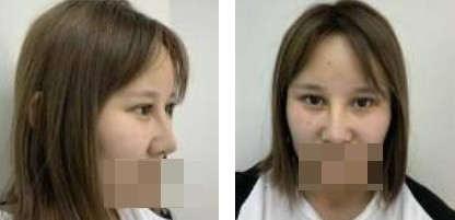 鼻綜合+眼綜合整形，讓我美的更自然，再也不用p圖了