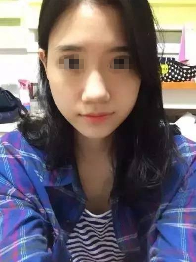 做完膨體隆鼻，鼻子變“挺”了