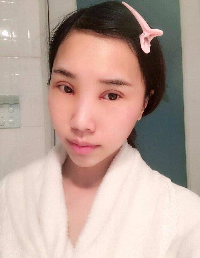 楊海平雙眼皮手術(shù)案例