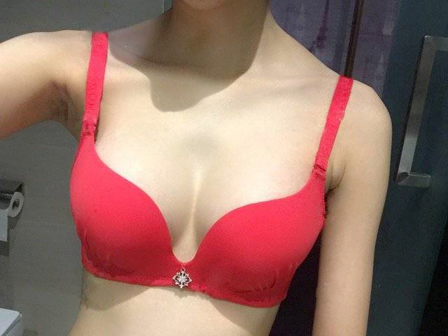 嘉興華山陳榮忠假體隆胸案例 嘉興華山陳榮忠假體隆胸案例