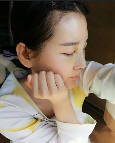 漢中韓美整形醫(yī)生常雙模假體隆鼻+耳軟骨墊鼻尖真實(shí)案例效果圖 漢中韓美整形醫(yī)生常雙模假體隆鼻+耳軟骨墊鼻尖真實(shí)案例效果圖