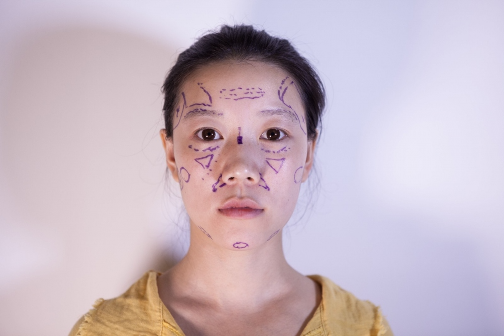 山西伊特雅整形醫(yī)生王鳳芹自體脂肪豐面頰+V-LINE瓜子臉手術案例效果圖