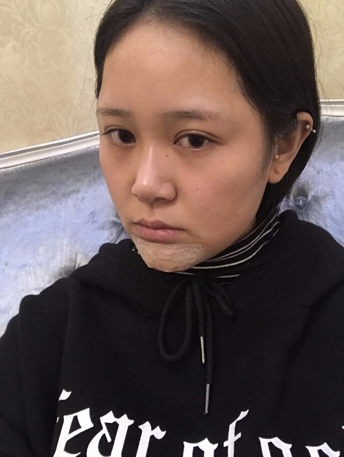 青島集美整形醫(yī)院做硅膠墊下巴怎么樣？趙煜楠醫(yī)生硅膠墊下巴真人案例