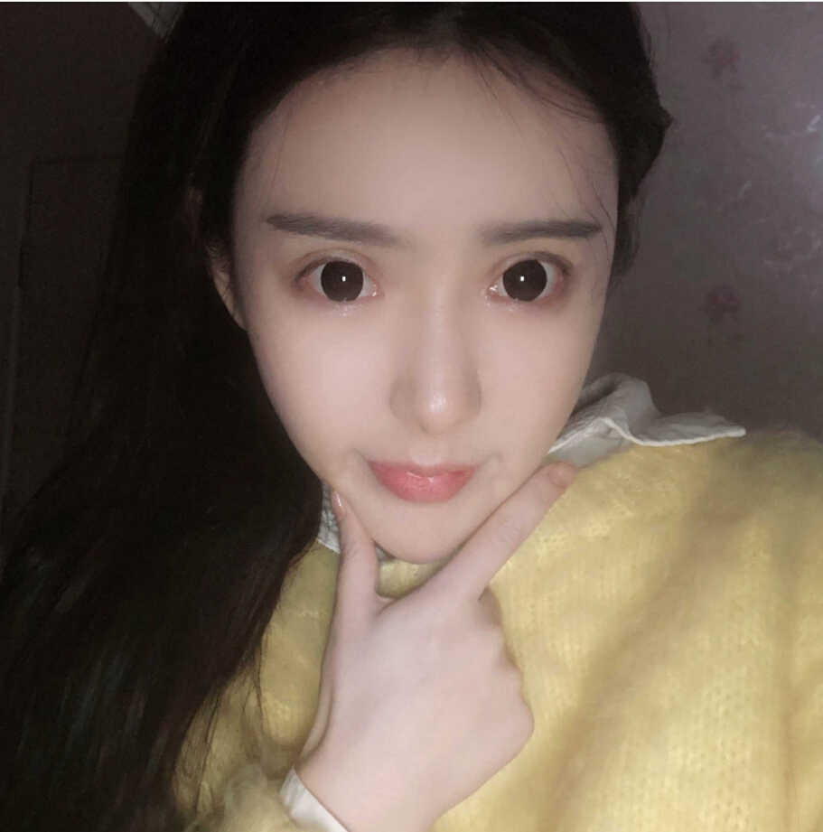 重慶柏漫醫(yī)療美容診所高紅艷醫(yī)生做面部吸脂怎么樣？面部吸脂案例分享