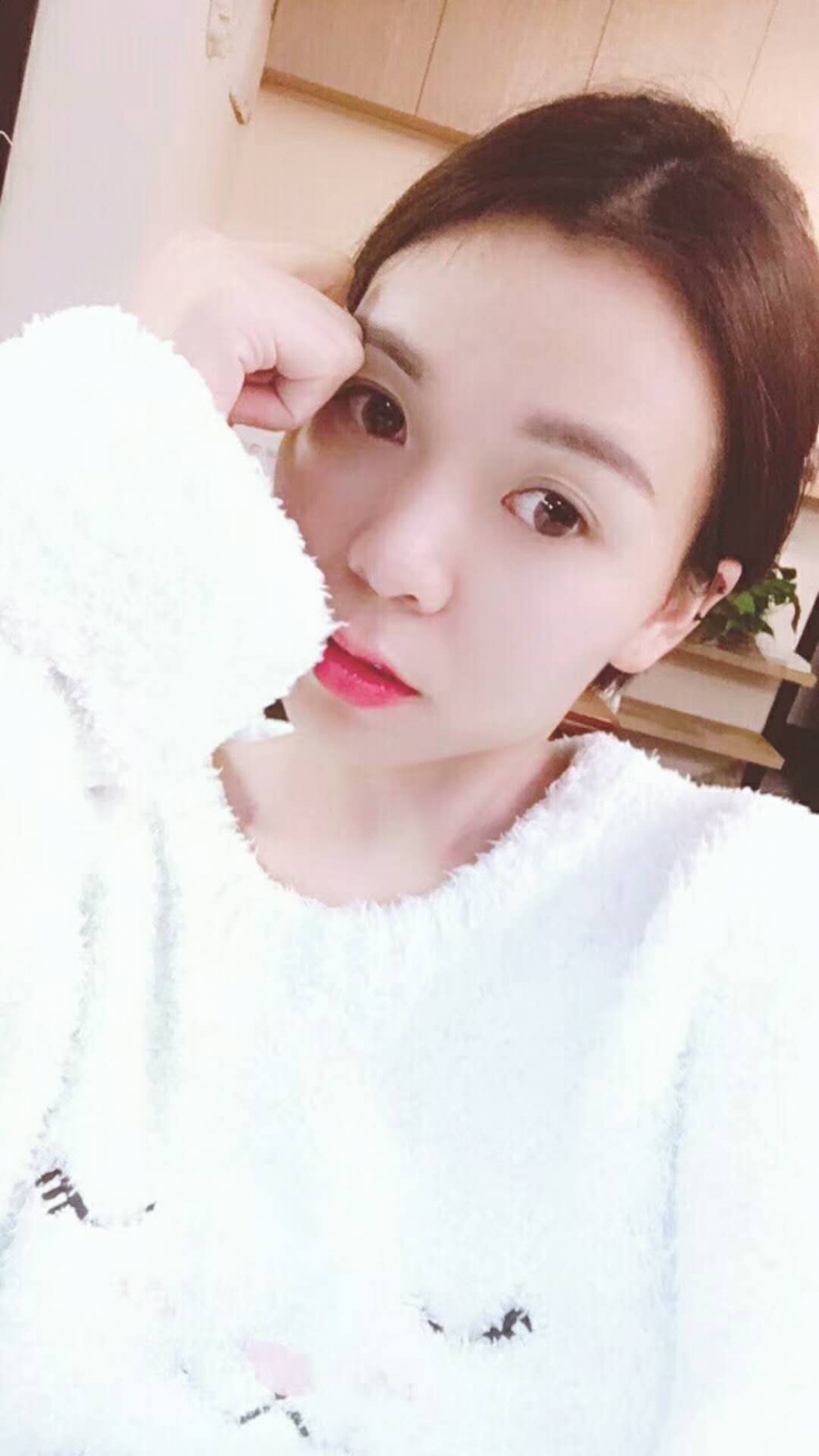 長沙星雅醫(yī)療美容醫(yī)院做埋線提升去法令紋效果怎么樣？附金振玉醫(yī)生案例