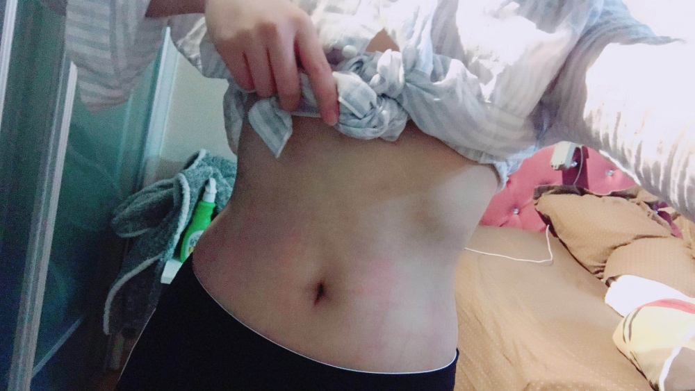 深圳晨曦整形醫(yī)院吉米斯做腰腹吸脂怎么樣？附吉米斯醫(yī)生腰腹吸脂案例