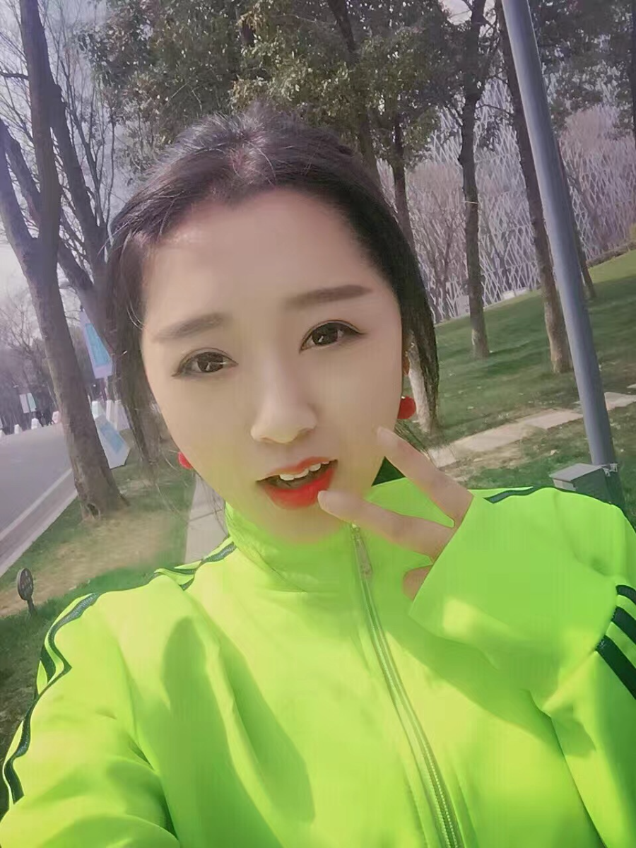 西安米蘭柏羽整形醫(yī)院李旭平做切開雙眼皮效果怎么樣？附案例